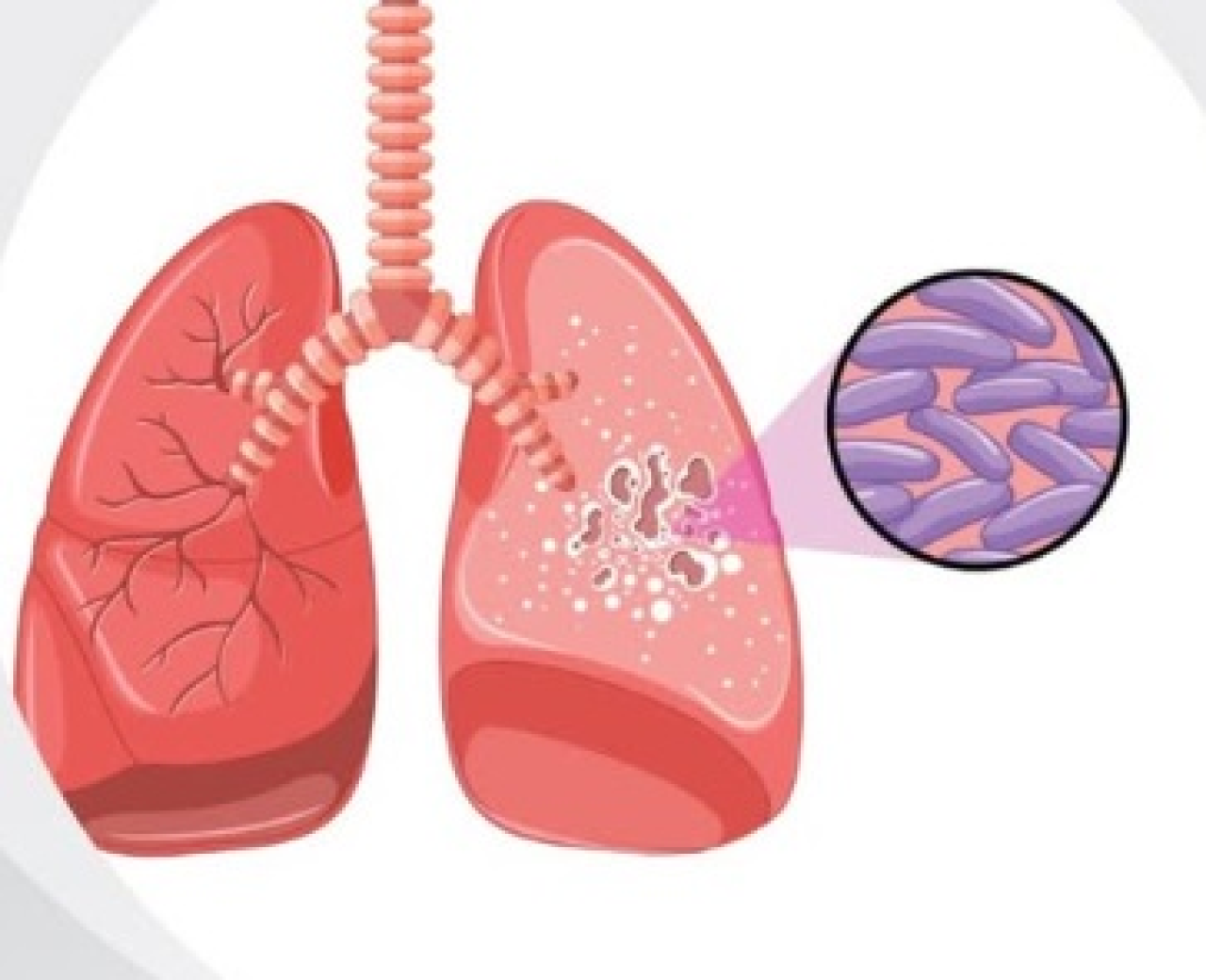 Understanding Latent TB: Symptoms, Risks, and Prevention